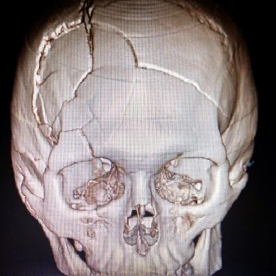 skull cracked from exploding pool filter